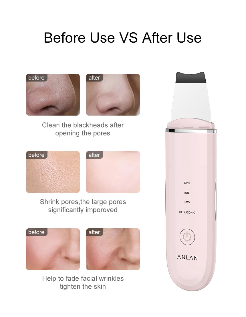 [Best-seller] ANLAN Ultrasonic Glow – Deep-Cleansing & Lifting Skin Scrubber